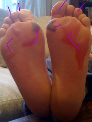 blister spots